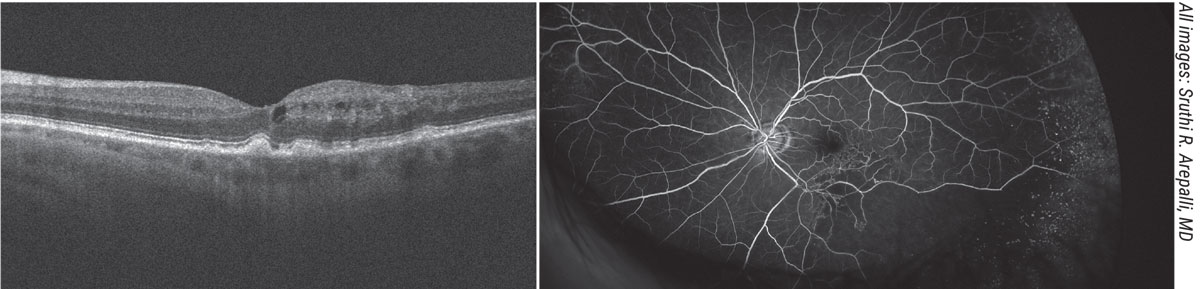 RevOphth's tweet photo. Experts explain how they work up + treat cases of pseudophakic CME, from the mild to the recalcitrant.
Read in our #RP2022inreview special issue or via the web version:
https://t.co/Hc0zSujzkX
https://t.co/X14xsWZgTy
#cataract #cataractsurgery #cataractsurgeon #ophthalmology https://t.co/qULWE9ViZP