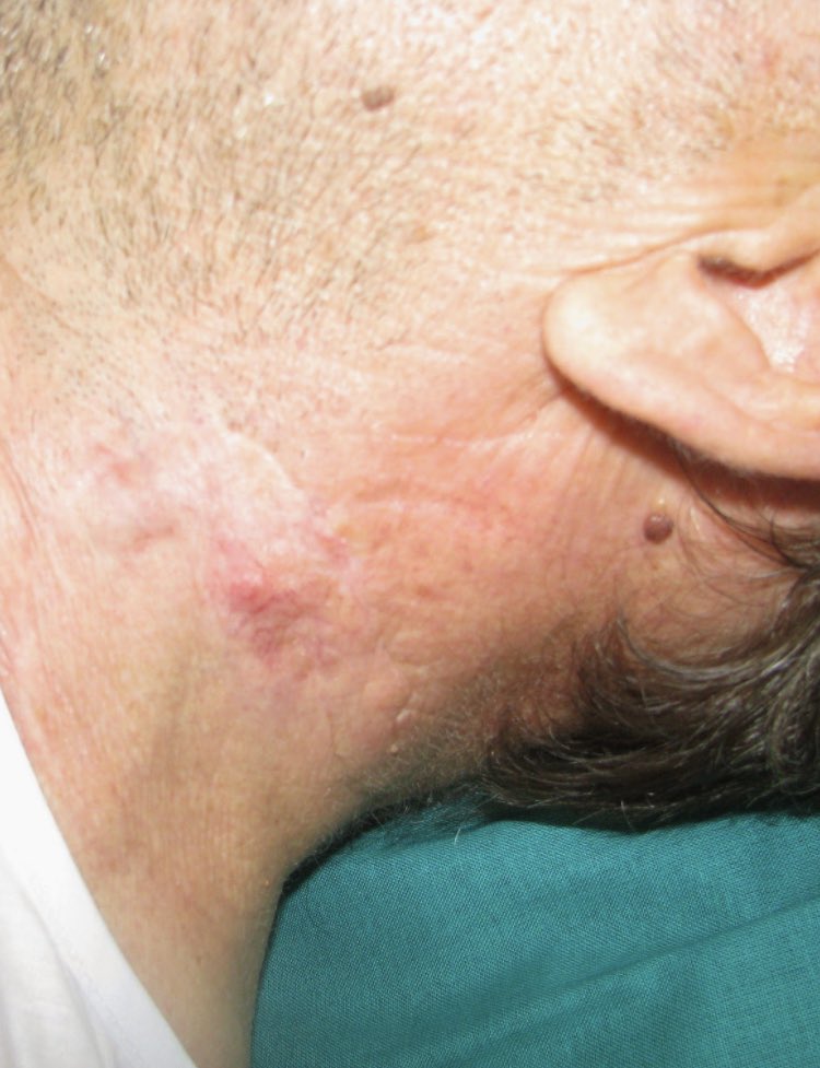 franvilmar's tweet photo. En cirugía dermatológica debemos conocer muy bien la anatomía que subyace a la piel. Aquí un claro ejemplo: carcinoma basocelular que coincide con el punto de Erb, zona donde el nervio auricular mayor emerge detrás del esternocleidomastoideo y está más desprotegido... https://t.co/kKdtRC4Hwr
