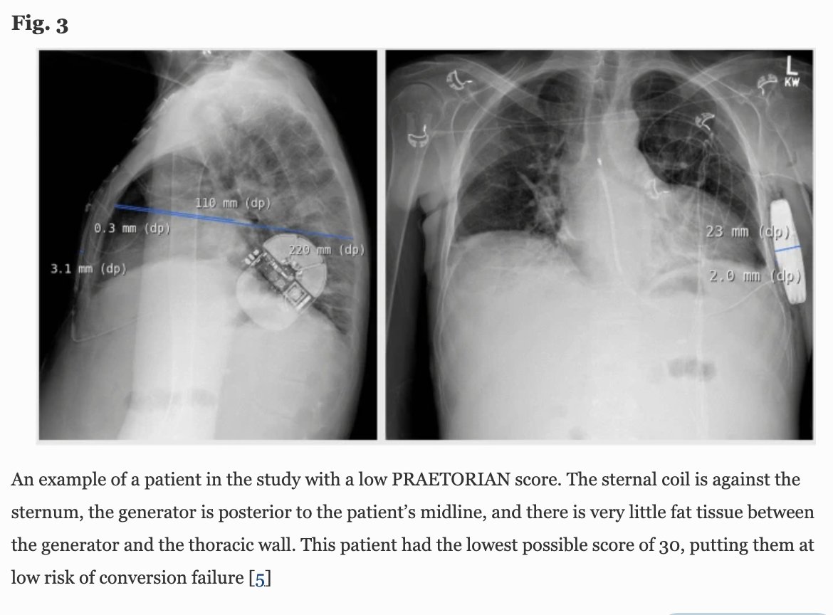 🚨 New #FreeRead in @JICE_EP S-ICD implantation position predicts successful defibrillation in obese & non-obese pts @clayhoster @GrahamPeigh @AnnasRahmanMD @NishantVermaMD @DrBradleyKnight @hhuang123 @krishmd @psharmadoc @JWasserlaufMD 📖🧐 rdcu.be/c2LEq #EPeeps