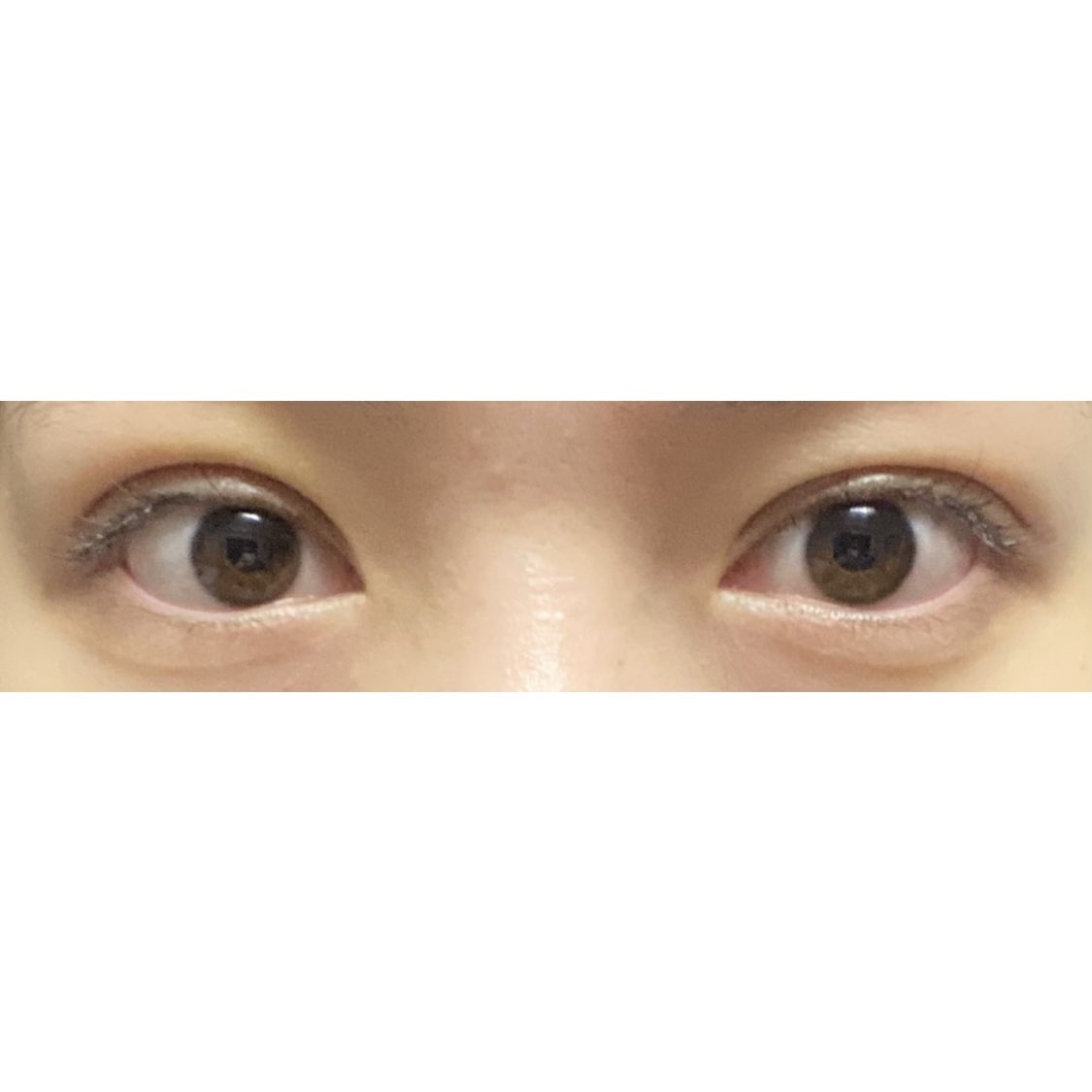 8_axuw's tweet photo. 湘南美容クリニック池袋東口院
赤尾先生指名
クイックコスメティークトリプルNeo
術後7日目📸

#二重整形 #埋没法 #整形 #美容 #美容整形 #二重 #クイックコスメティークトリプルNeo https://t.co/WXljsZM4Wu