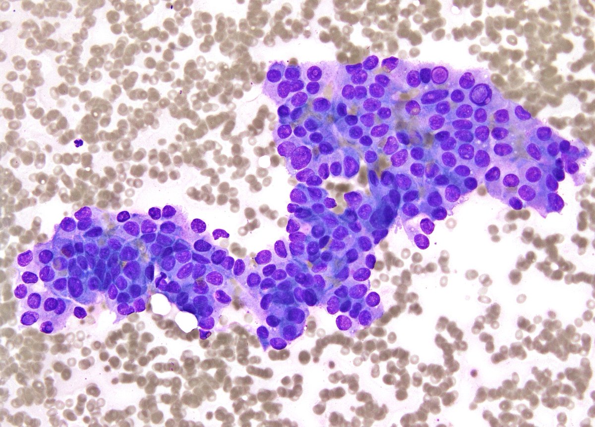 sza_jhcyto's tweet photo. Giemsa is never inferior to Papanicolaou stain to look for intranuclear inclusions (INCIs). Papillary Thyroid Carcinoma, FNA. https://t.co/FFUog683iD