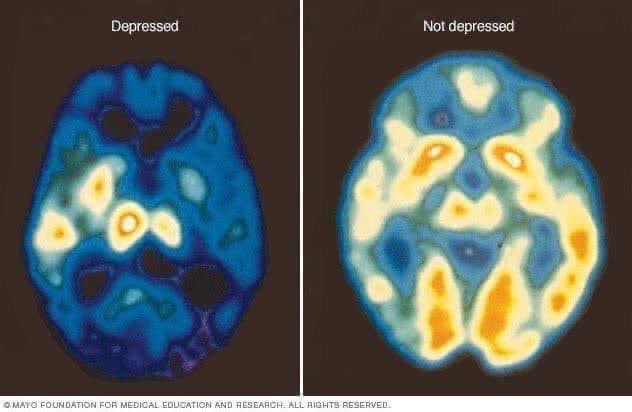 Yo entendí que la Depresión te pone PENDEJO🥴
Acá les dejo:
La Depresión es un trastorno del estado de animo causado por un desbalance de neurotransmisores.
Éste puede llegar a ser incapacitante y requiere medicación para su tratamiento
No es una "decisión" o "algo que se supera”