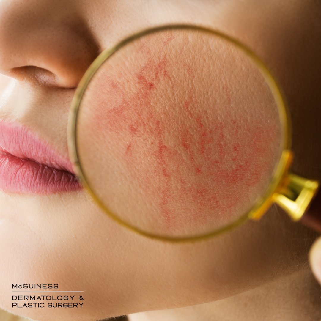 McGuinessDerm's tweet photo. Let's talk about Rosacea🗣️ 

What is it? It's a skin condition characterized by a redness in your complexion with apparent blood vessels on your face. Rosacea tends to flare up for a few weeks or months and then ease up

How can we treat Rosacea? Symptoms of Rosacea can be  ... https://t.co/bx58wjA9Ia