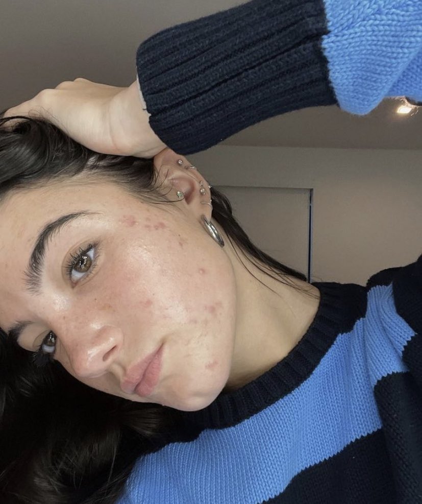 كيف تخلصت من الحبوب ببشرتي وايش الروتين الفعال لها تجربتي كاملة بهذا الثريد؟