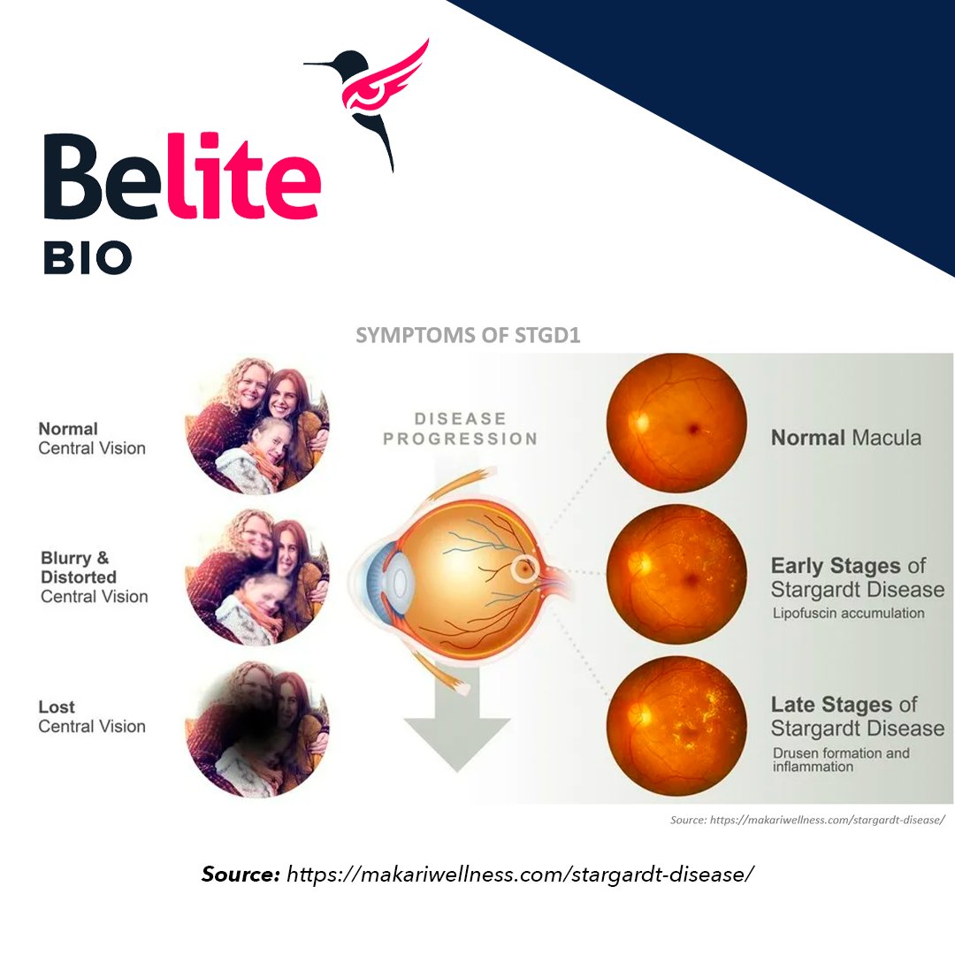 belite_bio's tweet photo. A great graphic that showcases the stages of Stargardt Disease. STGD is an inherited disorder of the macula. The macula is an oval-shaped pigmented area near the center of the retina that is responsible for the central, high acuity vision. #STGD

Source: https://t.co/j9xIT7jFbR https://t.co/n5qn3hQEt2