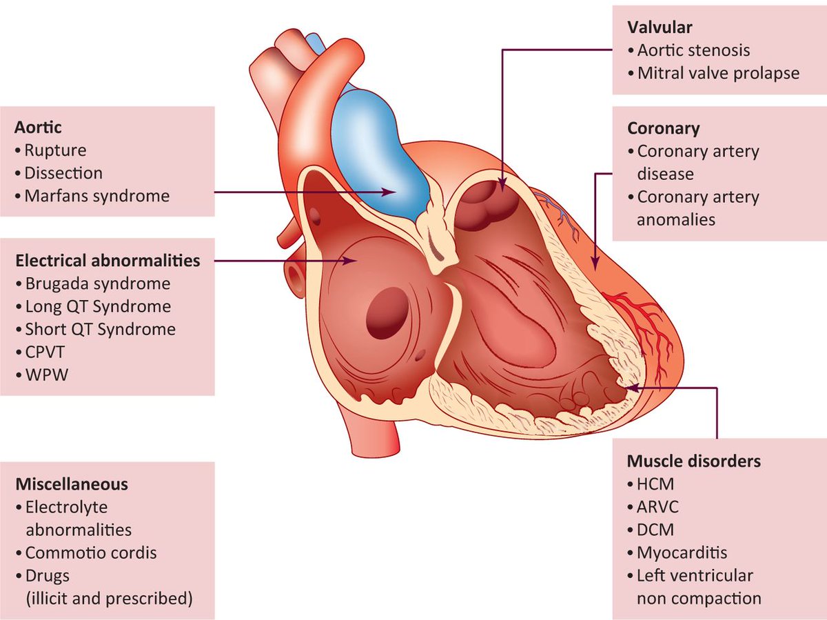 DharSaty's tweet photo. SUDDEN CARDIAC DEATH

Occurs within 1 hr of onset of symptoms
CAD (= 80%)

(Icy Idiots Chased Hot Vain Chimps)

Ischemic Heart disease (MI)
Inherited Channelopathies (QT syn)
Cardiomyopathies (-OH HCM Myocarditis)
Heart Failure (EF<35%)
Valve disease (AS)
Congenital disease (TOF) https://t.co/dMlIuXLDJg