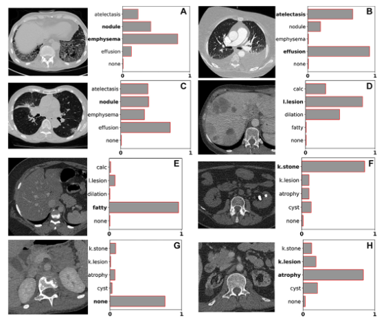 T1 Tushar et al. utilized a rule-based algorithm to extract labels from free-text radiology reports, which were used to train deep learning models to classify multiple diseases for three different organ systems from body CT scans. Impressive! #RadAIChat