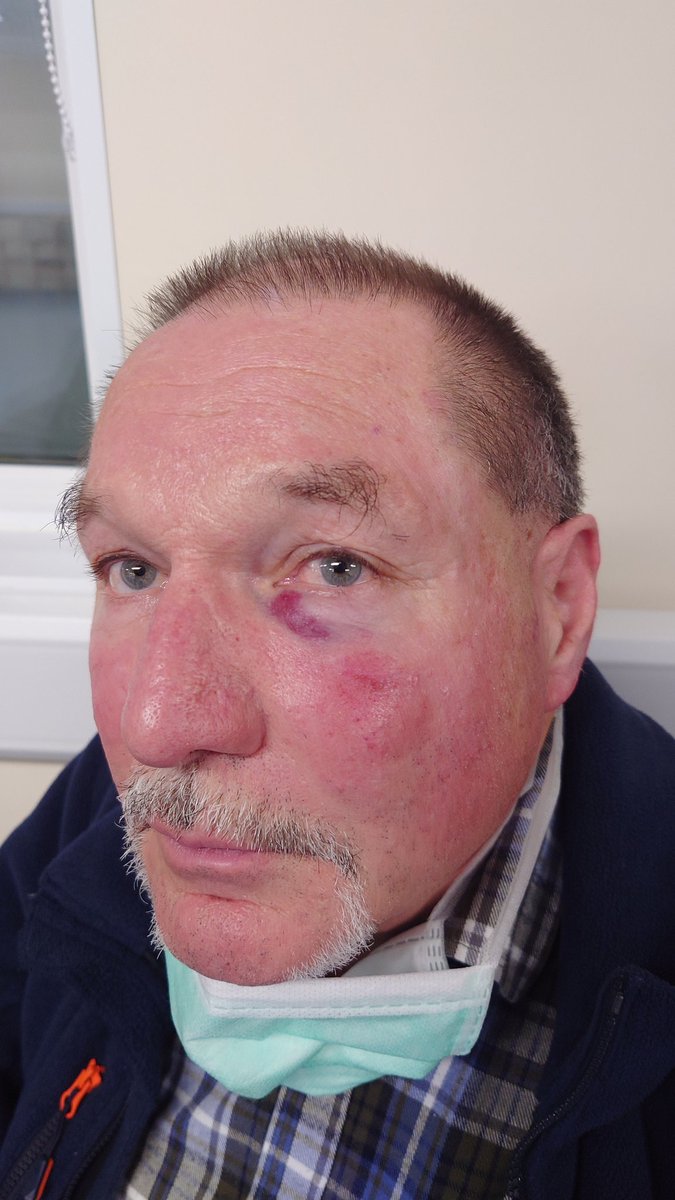 helloojamesy's tweet photo. This is Roland. He's my girlfriend's father. He's in Dublin visiting us from Switzerland. He doesn't speak English. He was punched twice in the face on Dublin Bus by a man saying "go back to your own country". @dublinbusnews https://t.co/EFE0fteaCZ