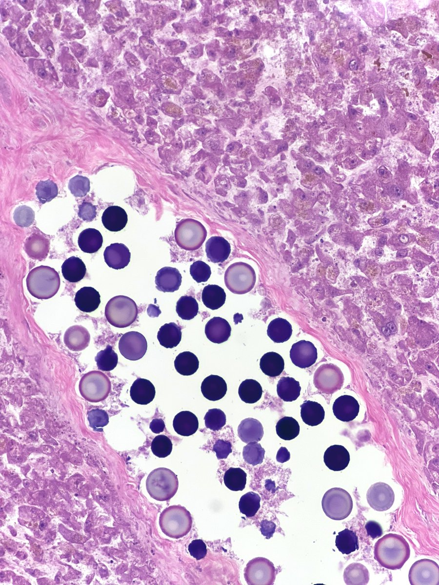 Liver section from an autopsy case including an interesting finding, who knows what these are and how they got there? #PathTwitter #GIpath #pathresidents #LiverPath #pathology