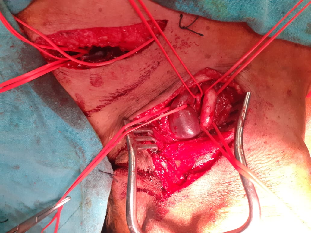 Professorial Clinics Vascular Surgery (@vascularclinics) on Twitter photo Type III dissection with gut symptoms. Rt VA non visualized Left arising from Aorta between Lt SCA and LT CCA. LT CCA to LT SCA bypass. Left VA to CCA transposition. Followed by TEVAR covering Left SCA upto Left CCA. <a href="/ThinkAorta/">Think Aorta</a> <a href="/AortaEd/">AortaEd</a> <a href="/fortis_hospital/">Fortis Healthcare</a> <a href="/AORTAjournal/">AORTA</a> Type III dissection with gut symptoms. Rt VA non visualized Left arising from Aorta between Lt SCA and LT CCA. LT CCA to LT SCA bypass. Left VA to CCA transposition. Followed by TEVAR covering Left SCA upto Left CCA. <a href="/ThinkAorta/">Think Aorta</a> <a href="/AortaEd/">AortaEd</a> <a href="/fortis_hospital/">Fortis Healthcare</a> <a href="/AORTAjournal/">AORTA</a>