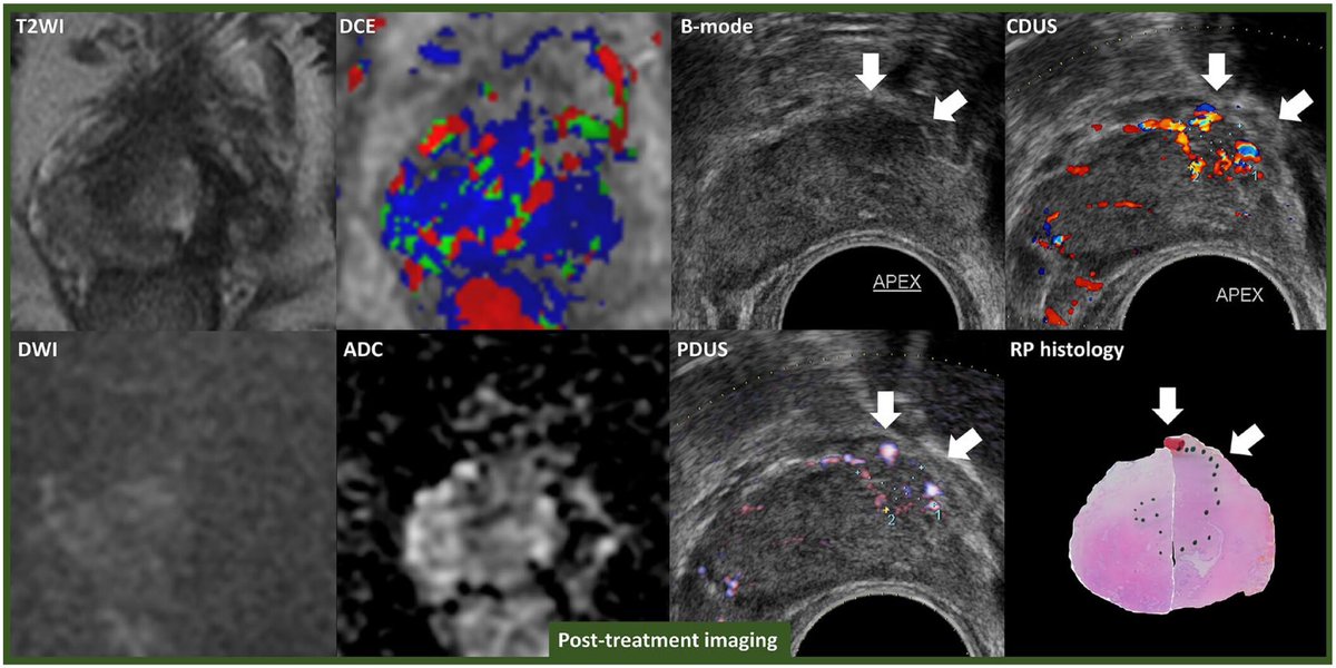 ALDCAbreu's tweet image. TRUS remains an important tool for #prostatecancer diagnosis, intra-OP guidance, immediate post-OP evaluation, and follow up assessment, even in the MRI era. Check this out