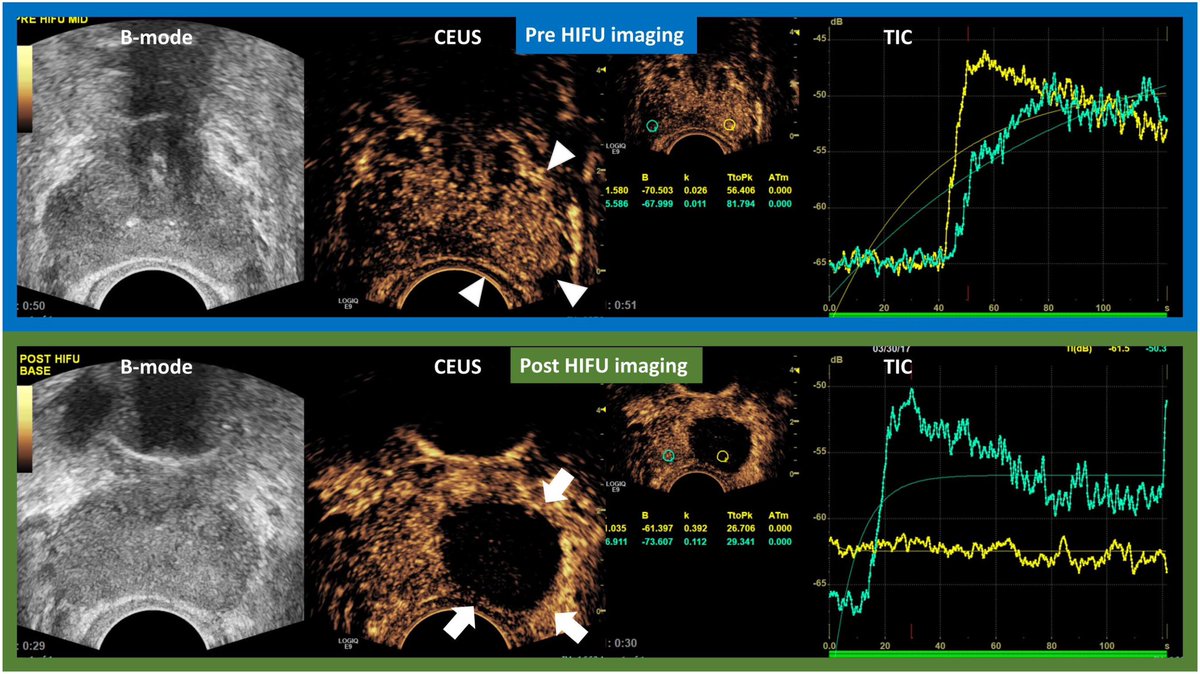 ALDCAbreu's tweet image. TRUS remains an important tool for #prostatecancer diagnosis, intra-OP guidance, immediate post-OP evaluation, and follow up assessment, even in the MRI era. Check this out