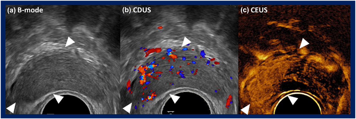 ALDCAbreu's tweet image. TRUS remains an important tool for #prostatecancer diagnosis, intra-OP guidance, immediate post-OP evaluation, and follow up assessment, even in the MRI era. Check this out