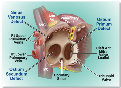 The sinus venosus, or systemic venous sinus, is the cardiac chamber with myocardial walls located upstream of the right atrium in tetrapods and the single atrium in fish. 
Kindy goes through this link to get more information: 
medical-case-reports.imedpub.com