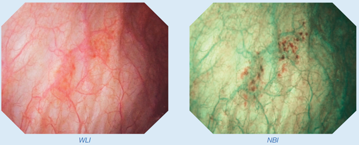 Did you know that Olympus optical technology #NBI (Narrow Band Imaging) facilitates early detection and can help you to advance patient care? 
Explore the principle and evidence behind and access a large video database at the NBI Portal
olympus.eu/NBI-Portal #education #urology