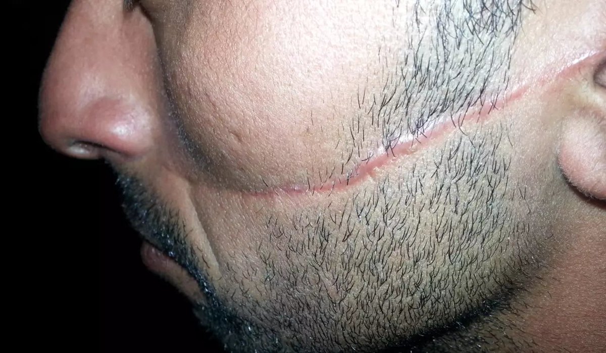 F_Desouche's tweet photo. Huit ans après avoir été défiguré par Hassen S. à Nice, cet homme espère que son agresseur sera jugé. Le suspect, au lourd casier judiciaire « a bénéficié jusqu’à présent d’une étonnante mansuétude de la justice »
https://t.co/SqQuYHIxgA https://t.co/XYbVPO6gVN