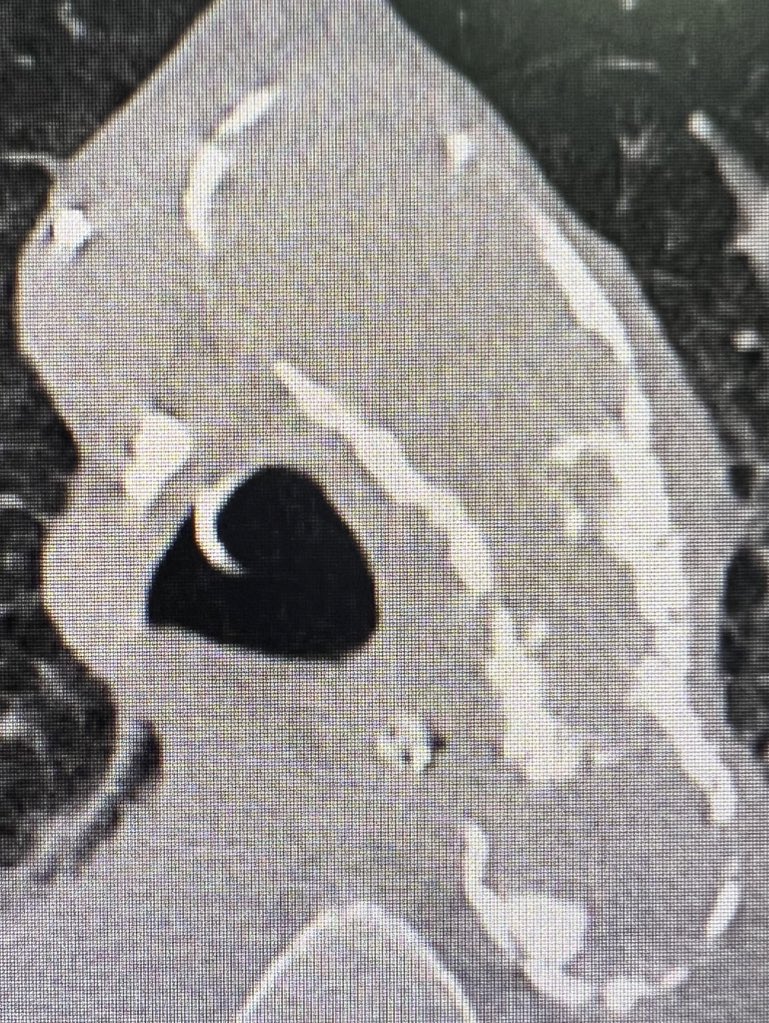 Juan Carlos Rama (@jcarlosrama_) on Twitter photo Enfermedad coronaria multivaso calcificada (CD crónica). Insuficiencia mitral grave. Lo presentamos a cirugía? 🫣#Aorta🏺 <a href="/BrunoLimpo/">Bruno Limpo</a> <a href="/Otarrec/">Pablo C.G.</a> <a href="/shci_sec/">ACI-SEC: Hemodinamica</a> Enfermedad coronaria multivaso calcificada (CD crónica). Insuficiencia mitral grave. Lo presentamos a cirugía? 🫣#Aorta🏺 <a href="/BrunoLimpo/">Bruno Limpo</a> <a href="/Otarrec/">Pablo C.G.</a> <a href="/shci_sec/">ACI-SEC: Hemodinamica</a>