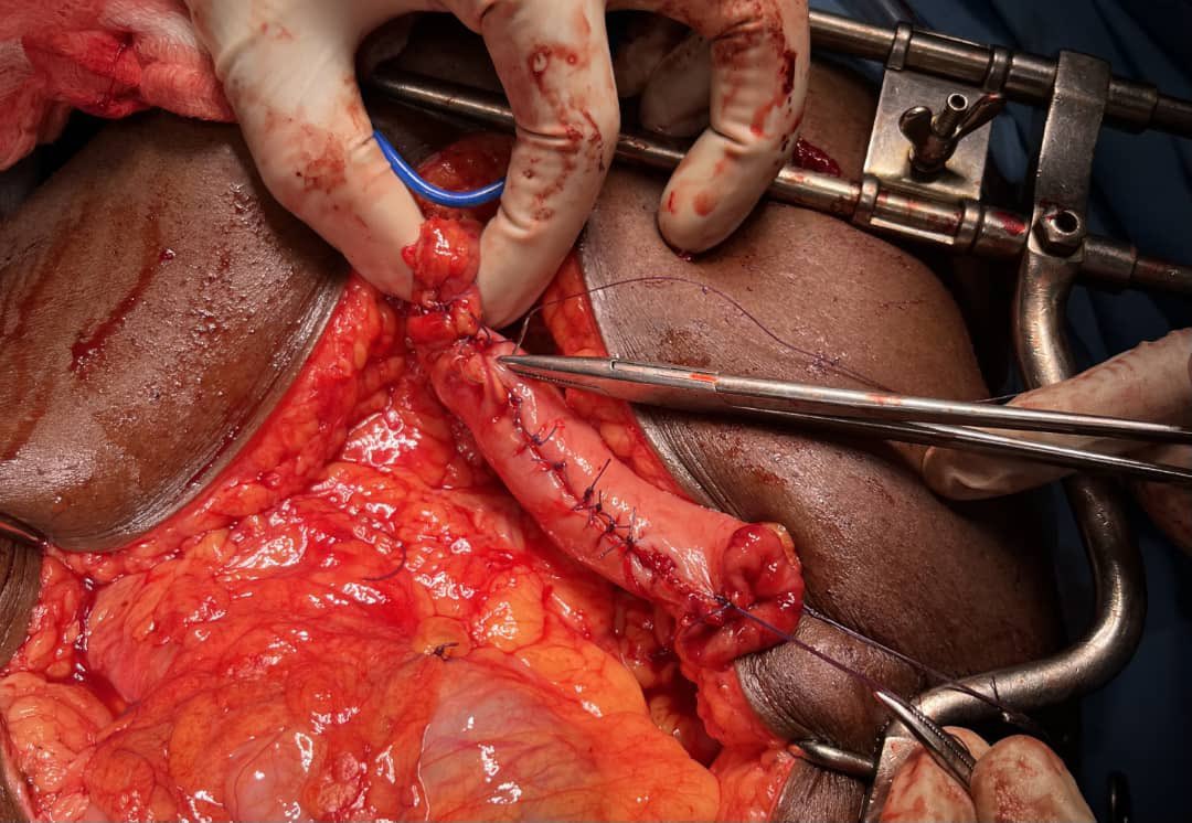 Antibiotic prophylaxis reduces the risk of endometritis by approxymately 60 percent in both antepartum and intrapartum cesarean births , this session of January <a href="/SPOOA_PM_AFRICA/">SPOOA-PM AFRICA OFFICIAL</a> will build capacities in infections in surgery <a href="/SaferSurgery/">Lifebox</a> <a href="/BucksUSGRA/">BucksUSGRA</a> @KingsKCP <a href="/Smiletrain/">Smile Train</a>