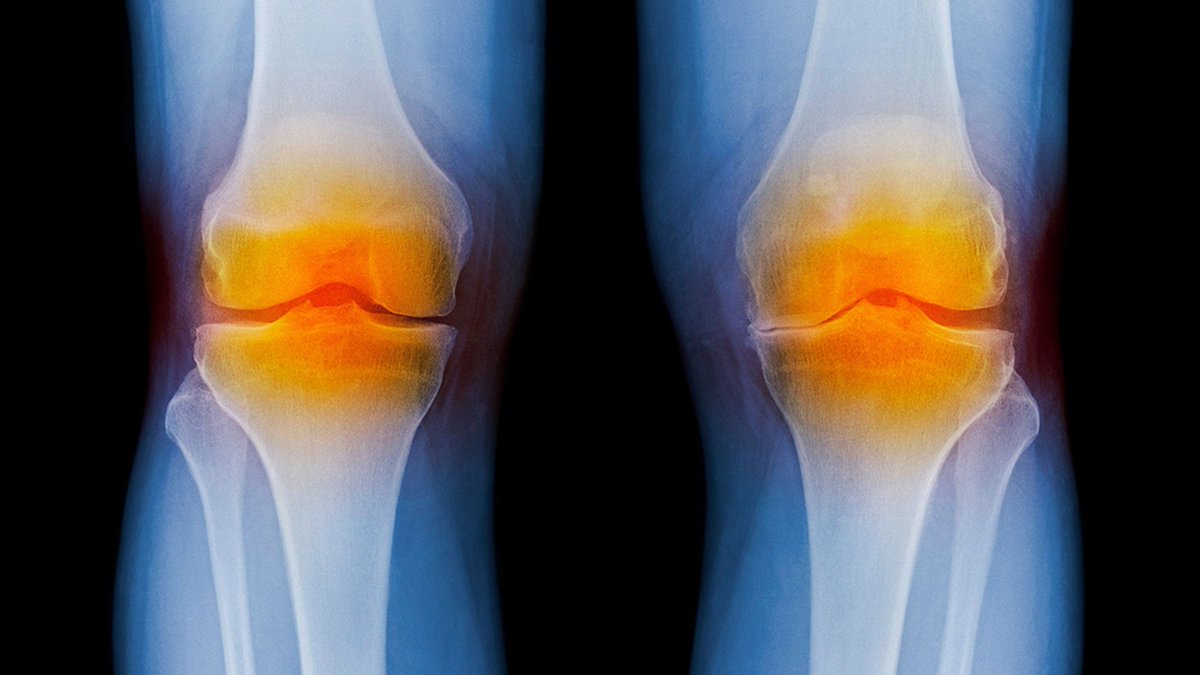 Michele Marcolongo, PhD PE, the Drosdick Endowed Dean of the Villanova’s College of Engineering, partners with fellow researchers to develop breakthrough therapy for osteoarthritis. 

www1.villanova.edu/vu/magazine/fa…