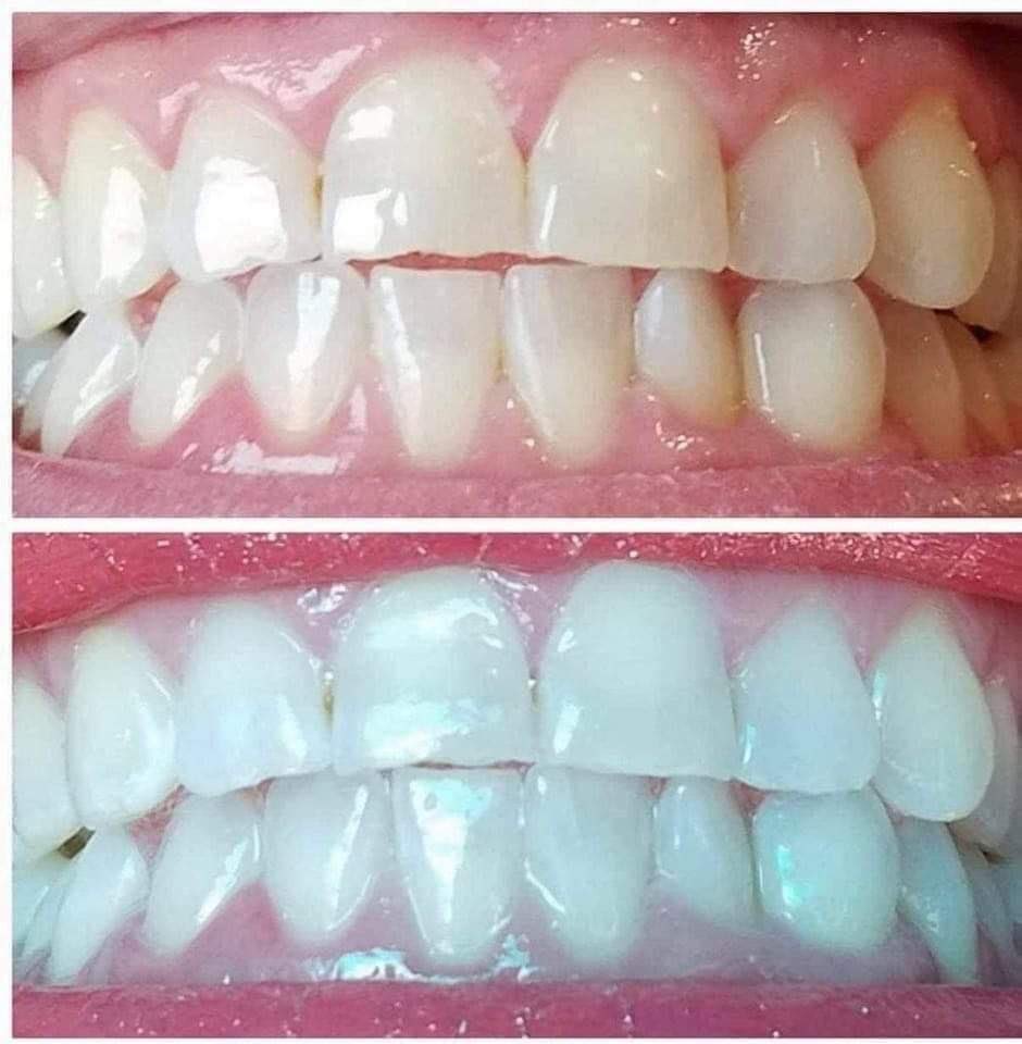 tinkerdijah_17's tweet photo. All you do is brush 2x daily and let the toothpaste do the rest of the work. There are some results below! I already have a list in the making, let me know if you want me to add you. https://t.co/vu2jKv6uyO