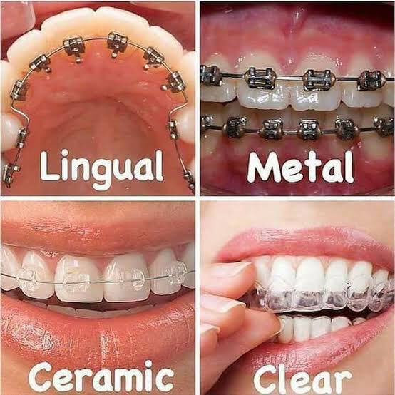 Dental_preneur's tweet photo. The 5 different types of braces 

A thread https://t.co/zmhIvOD3sb