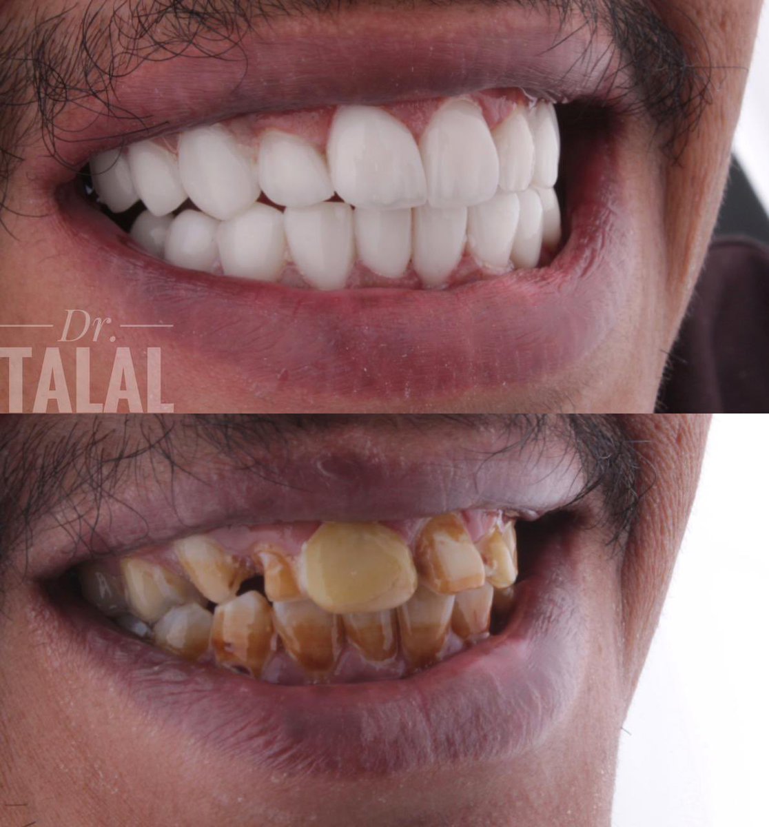 beaupalace1's tweet photo. #عيادات_اسنان  #الخميس_الونيس لا تأجل علاج أسنانك وتجميلهم مع عروضنا المميزة للأسنان في بداية العام احجز للحصول على إبتسامتك الفريدة 😁 للحجز و الاستفسار📞 0552557304 https://t.co/LVwq8mjNVr
