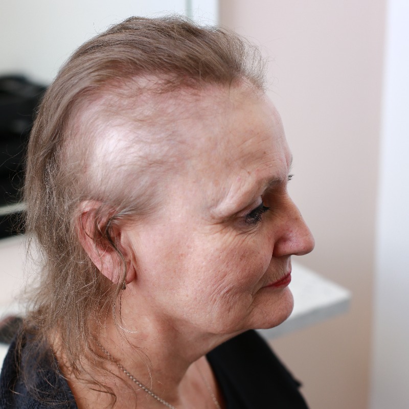 HairSolved's tweet photo. Clients find the Enhancer System to be a complete solution for both the physical and emotional effects this female hair loss condition can cause. We transform our client's hair loss and confidence.
#femalepatternbaldness
#femalepatternhairloss #androgenicalopecia