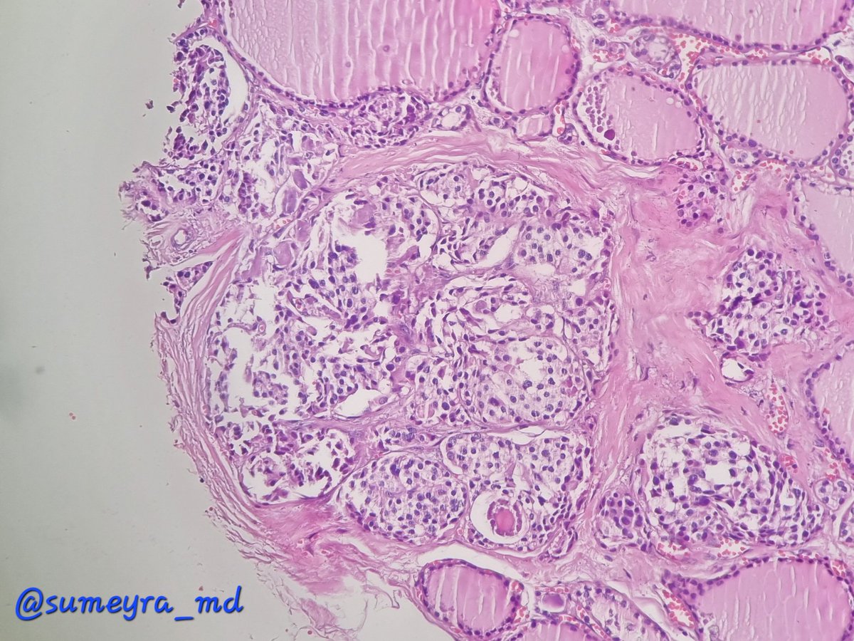 sumeyra_md's tweet image. First case of 2023☃️ #PathTwitter #Endopath #Pathresidents