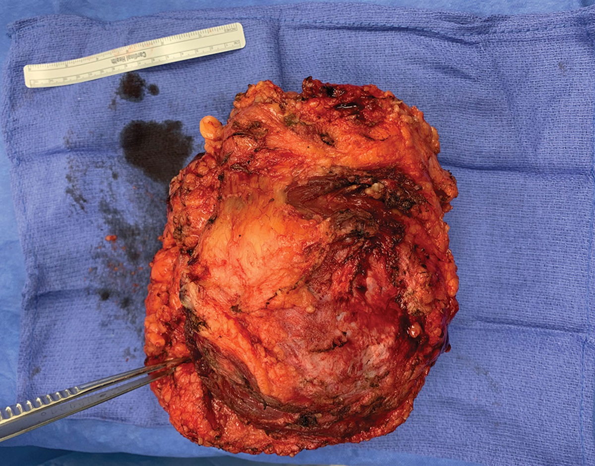 Trending in PRS Breast Implant Capsule–Associated Squamous Cell Carcinoma during Pregnancy: A Mimicker of Breast Implant–Associated Anaplastic Large-Cell Lymphoma dlvr.it/SgQgJY