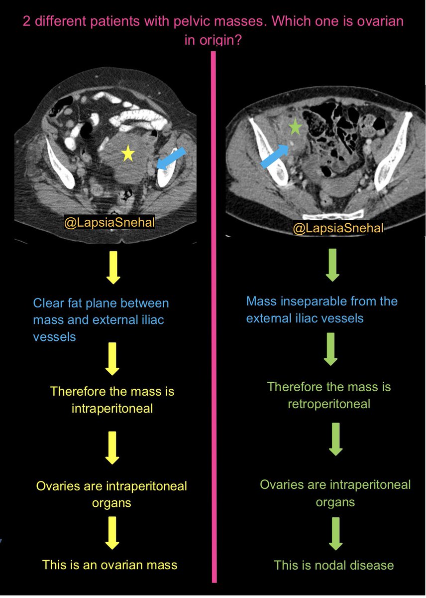 Pelvic masses can cause diagnostic uncertainty. This tip may help. #FOAMrad #FOAMed #meded  #radres #futureradres #medstudenttwitter #gitwitter #anatomy #frcr #surgery #radiology #radtwitter #medtwitter #gyn #obygyn #abdrad