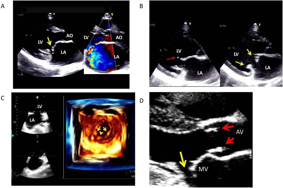 NEW GUIDELINE: Read our newest #guideline, "Recommendations for the Use of Echocardiography in the Evaluation of Rheumatic Heart Disease," in our January <a href="/JournalASEcho/">JASE</a>! bit.ly/3vMohPf
