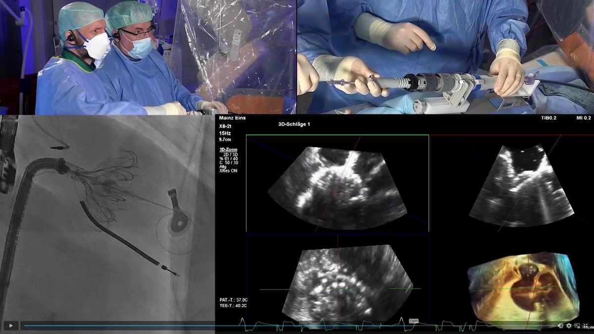 vonBardelebenRS's tweet photo. #PCRLV 2022 opening live cases from #Copenhagen with Lars Sondergaard and #Mainz with @vonBardelebenRS and an #Edwards #Evoque #Tricuspid #replacement #TTVR transvenous transfemoral onging #TRISCEND II trial
https://t.co/R4j0EM0woi https://t.co/veDU2YJE6w