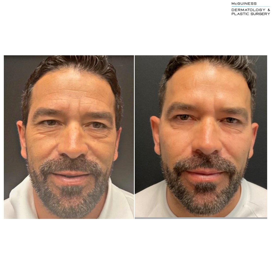 McGuinessDerm's tweet photo. Before &amp; After 2 weeks post treatment

This patient received Botox to his crows feet, glabella and forehead. He also got 4 syringes of Voluma in the cheeks. 

Treated by Lana in the Murphy office 
📞 Call 972-316-4455 to make an appointment 
💻 https://t.co/xJzzQy72tV for mor ... https://t.co/S9hDuFKrMD