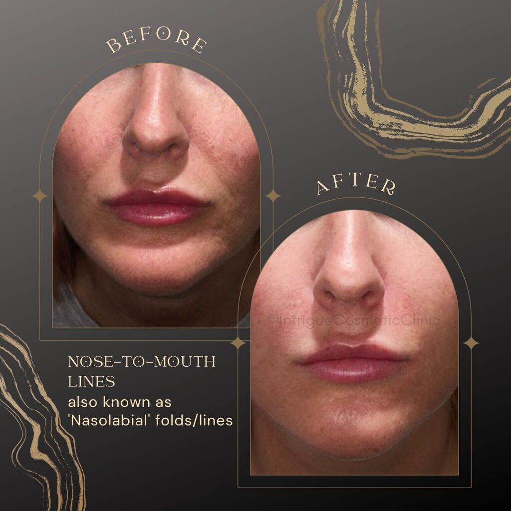 As our skin ages and we begin to gradually lose collagen, facial expressions can begin to cause deeper lines and wrinkles. Most of us will tend to notice the lines from the bottom of the nose to the corners of the mouth, also known as nasolabial folds, b… instagr.am/p/CnC0SaQNEhS/