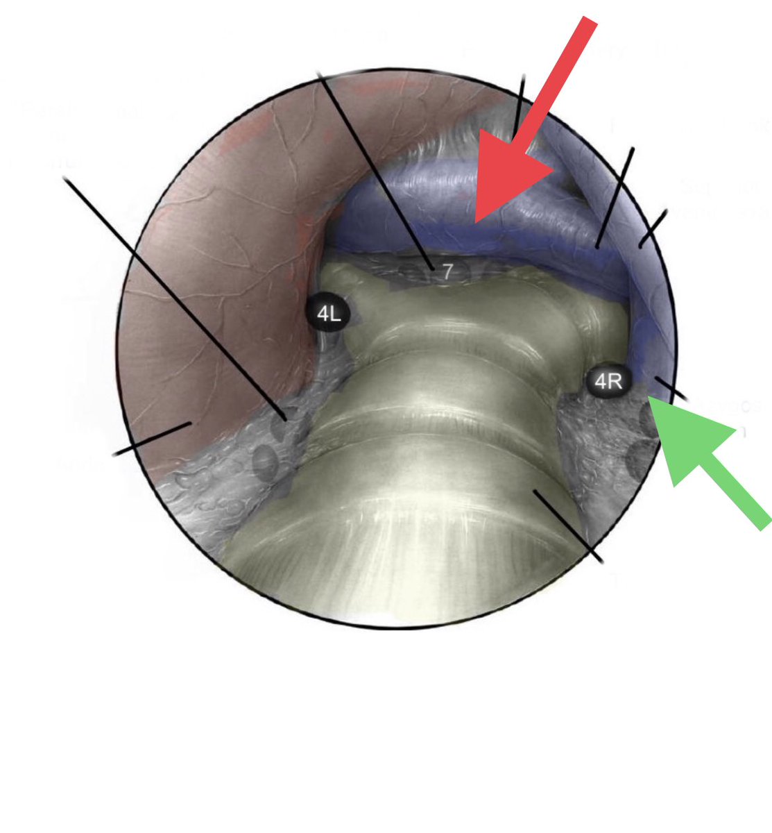 HAPPY NEW YEAR!!  It’s that time…THORACIC THURSDAY!!   Let’s do it! 

1) What procedure is pictured below?
2) What structure is the red arrow pointing to?
3) what structure is the green arrow pointing to?

#thoracicthursday #surged #MedEd