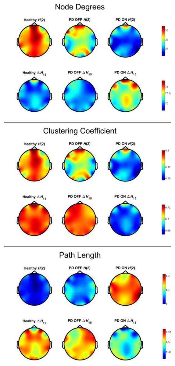 Orestis Stylianou, MD PhD (@o_stylianou) on Twitter photo Here we explored how the multifractal functional connectivity changes after dopaminergic treatment (DT) in #Parkinsons patients. After DT the constructed networks are more connected/integrated and less segregated. tinyurl.com/29me9cbr
<a href="/_PetraRitter/">Petra Ritter</a>
<a href="/AcademicEEG/">AcademicEEG</a> Here we explored how the multifractal functional connectivity changes after dopaminergic treatment (DT) in #Parkinsons patients. After DT the constructed networks are more connected/integrated and less segregated. tinyurl.com/29me9cbr
<a href="/_PetraRitter/">Petra Ritter</a>
<a href="/AcademicEEG/">AcademicEEG</a>