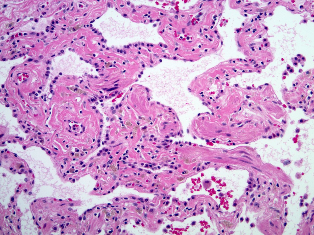 Jerad Gardner, MD on Twitter "RT smlungpathguy Smokingrelated interstitial fibrosis (SRIF