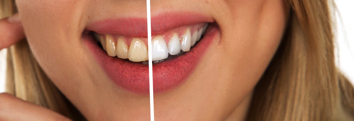 AccumulatedInt's tweet photo. I Just published a new article on my blog: 'Top 10 Teeth Whitening Products.' Check it out for a round-up of the best products to get a brighter, healthier smile! 

Medium:
https://t.co/ozpEjjHNzW

#teethwhitening #dentalhealth #selfcare #beauty #Health #twitter #blogger #AIblog https://t.co/XvjKpJdUMJ