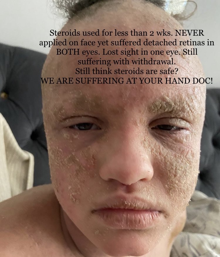 topicaldebate's tweet photo. @kjmck98 How long is your placement? Be interesting to know how often they prescribe steroids? Advise for you as a receptive newcomer,read up on #topicalsteroidwithdrawal &amp; have a discussion with those Gp’s &amp; witness the #gaslighting &amp; #patientblaming in response.Then ask about #kickbacks https://t.co/Ddh5byXDM1