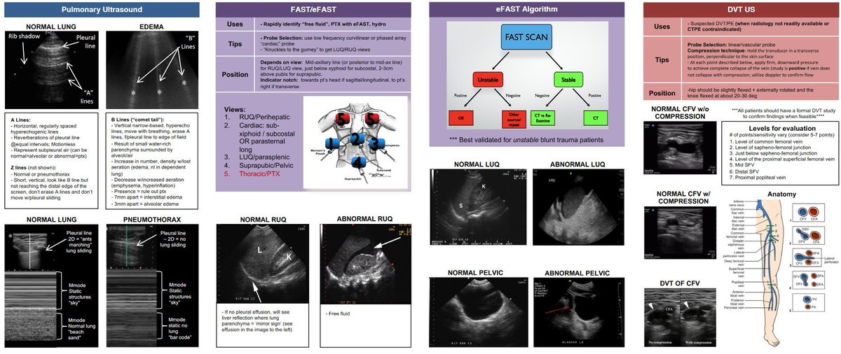 What all Anaesthetist must do!!!🤝#POCU. At all your #emergencydepartments, and #ICUs
Read more at #NephroP #ultrasound 
<a href="/_2017basa/">BASA🩺💉</a> <a href="/UAHPAssociation/">Uganda Allied Health Professionals Association</a> <a href="/AnesthesiaUg/">Association of Anesthesiologists of Uganda</a> <a href="/MUST_EM/">Emergency Medicine- Mbarara University</a>