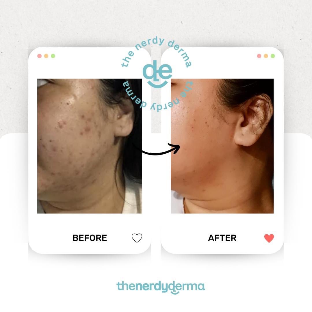 The Nerdy Derma® on Twitter: "Using skincare yet still not getting