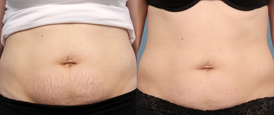 Do you have stretch marks on your stomach, arms, thighs, or somewhere else? Visit Suddenly Slimmer Med Spa 3313 E. Indian School Rd Phoenix for Stretch Mark Reduction Treatment with Alma. 602-952-8446
 suddenlyslimmer.com/stretch-mark-r…
#stretchmarks #pregnantbelly #pregnantphoto #bodyproud