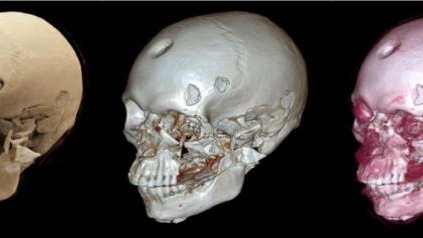 Delve into the world of skeletal trauma analysis and interpretation with the VIFM’s Forensic Anthropologists in a four-day intensive course from the 4th to 7th of July 2023. Places are limited so register now at vifm.org/skeletal-traum….