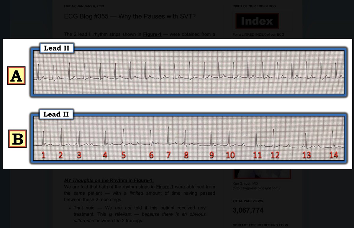 Ken Grauer MD on Twitter: quot These 2 rhythm strips were obtained from a
