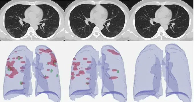 gp_pulipaka's tweet photo. Mild Infection Results in Long #COVID19 In Most Of Cases! #BigData #Analytics #DataScience #AI #MachineLearning #HealthTech #IoT #IIoT #Python #RStats #TensorFlow #JavaScript #ReactJS #CloudComputing #Serverless #Linux #Programming #Coding #100DaysofCode 
https://t.co/4fnX5jWvyh https://t.co/fzkU2ZNr4M
