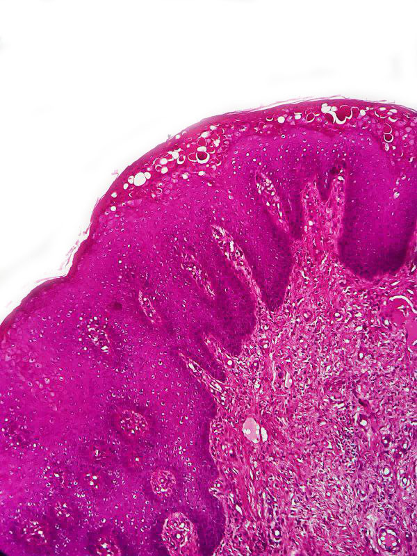 GeronimoJrLapac's tweet photo. ⚠ Anal Pagetoid dyskeratosis may be confused with molluscum contagiosum and condyloma acuminata. 
🎯TIP: Exuberant intraepithelial keratinization with cells showing cytoplasm with pink keratin and round and small nuclei.
🔥https://t.co/QeRbmS9ygW

Pic: Dr. Basharat Mubeen https://t.co/0JnCyWftRS