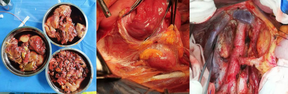 As usual, today is a busy day. Suspected lymphoma-ovarian metastasis; biopsies of mesenteric lymph nodes+unilateral salpingo-oophorectomy. Primary carcinosarcoma of the ovary. Staging surgery for UPSC with pelvic LN M.