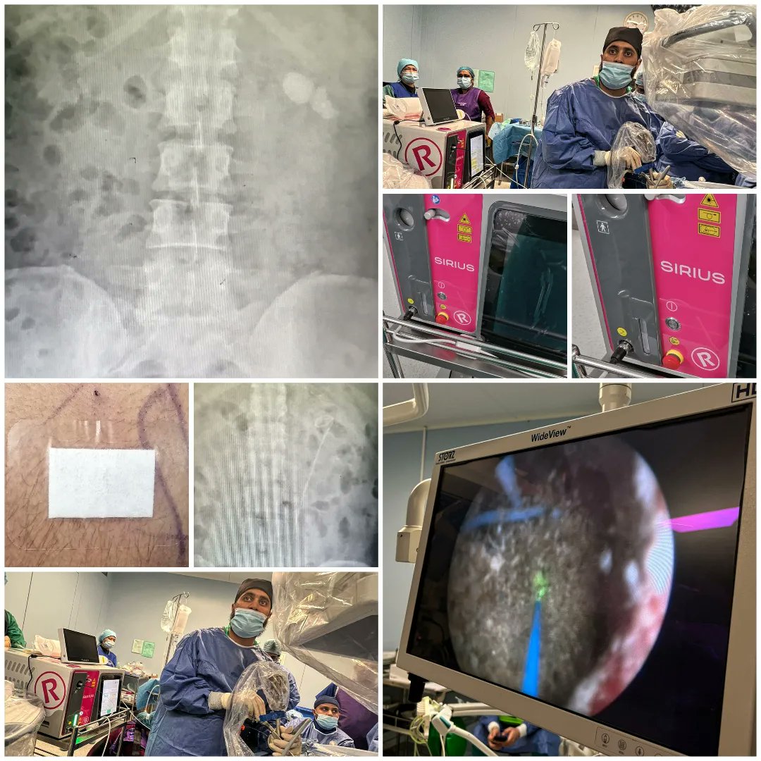 Urologist_Ahmad's tweet photo. #Endourology &amp; #UroTechnology
are together hand by hand 🤝🏼

Case of #ECIRS #miniPNL #RIRS
With #LASERlithotripsy
#TFL #ThuliumFiberLaser #thuliumfiberlaser #Siriusthuliumfiberlaser #SiriusRocamed #Rocamed

TFL is a game changer in Endourology &amp; Urolithiasis Management
@rocamed https://t.co/CHnHtcb4m5