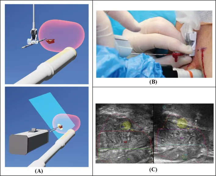 Vector Prostate Biopsy: A Novel MRI/Ultrasound Image Fusion Transperineal Biopsy Technique Using Electromagnetic Needle Tracking Under Local Anaesthesia buff.ly/3VSVuTU 

<a href="/ProstateCambrdg/">Christof Kastner</a> <a href="/ippoliti_simona/">Dr Simona Ippoliti, MBBS, MCh, MRCS</a> <a href="/luca_orecchia/">Luca Orecchia</a> <a href="/pjscharlesworth/">Philip Charlesworth</a> <a href="/Tristan_Radiol/">Tristan Barrett</a>