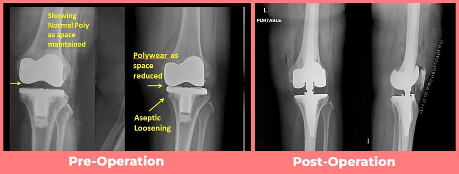 𝐑𝐞𝐯𝐢𝐬𝐢𝐨𝐧 𝐊𝐧𝐞𝐞 𝐑𝐞𝐩𝐥𝐚𝐜𝐞𝐦𝐞𝐧𝐭 𝐬𝐮𝐫𝐠𝐞𝐫𝐲
Call Us: +91-11235386000
For more info: sphdelhi.org
ditodelhi.com
#sph #santparmanandhospital #psshdelhi   #ditodelhi #kneereplacementsurgery #kneesurgeon
#KneeReplacementSurgeon